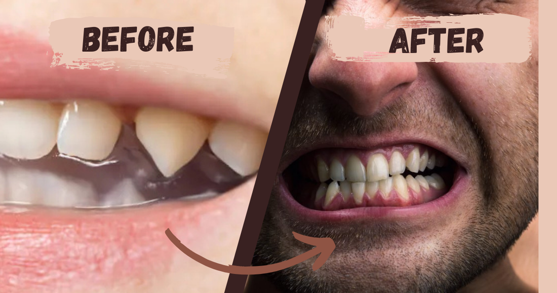 What Does Teeth Look Like Before and After Grinding?