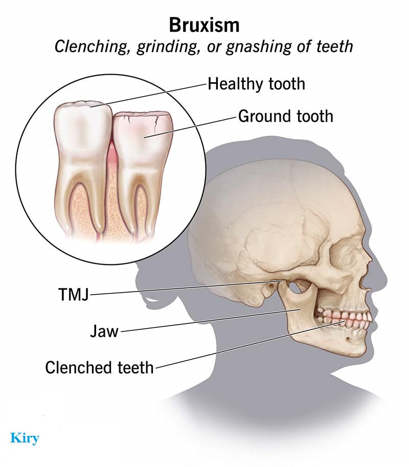 what is Bruxism