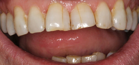 Craze Lines on Teeth: Causes, Treatment, and Prevention