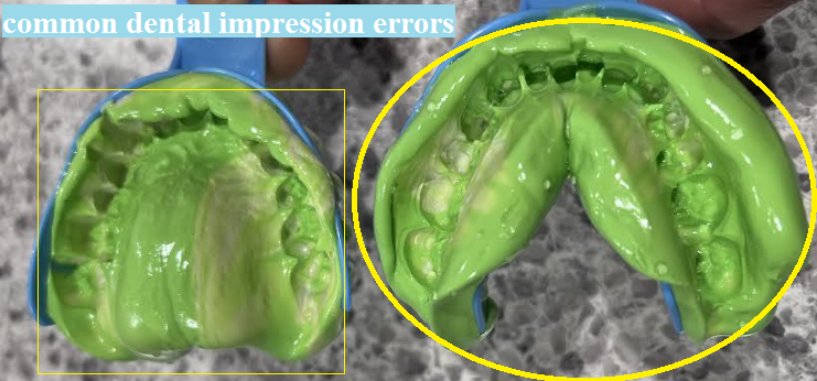 common dental impression errors